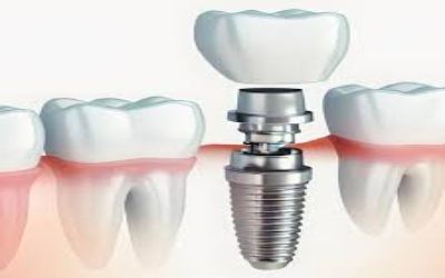 Helix Dental Implant Foundation |Dental Clinic in KK Nagar | Best Dentist in KK Nagar | Dental Care in KK Nagar.